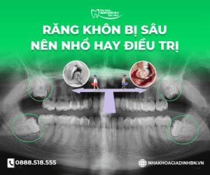 răng khôn bị sâu nên nhổ hay điều trị