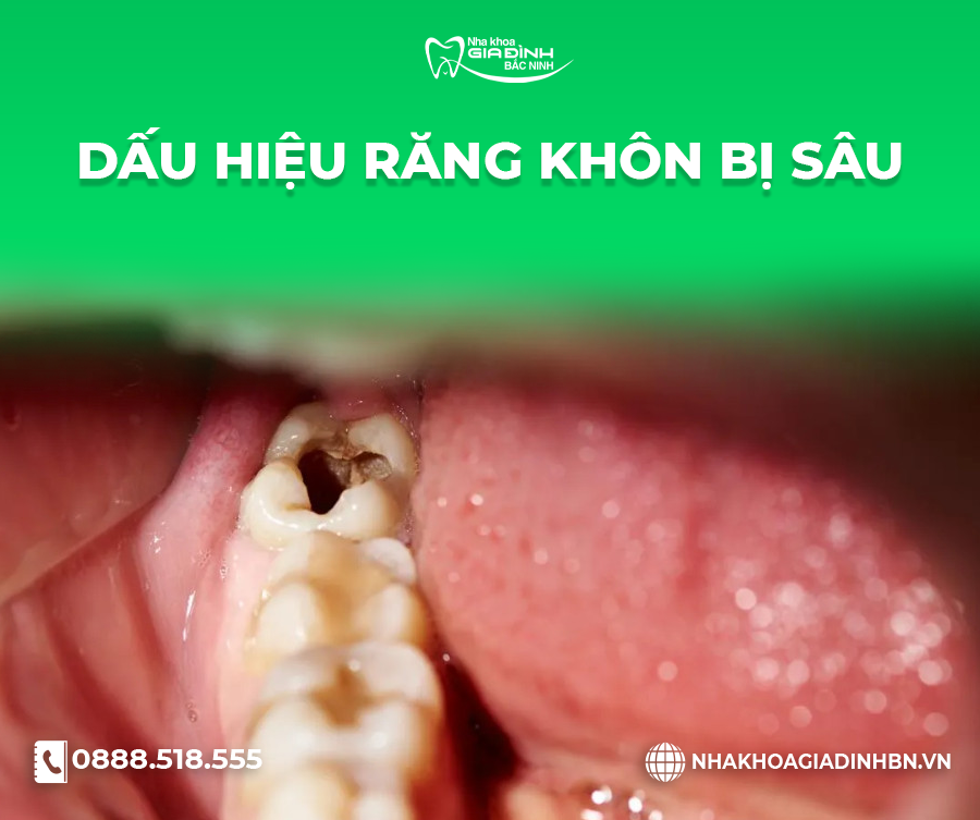 răng khôn bị sâu