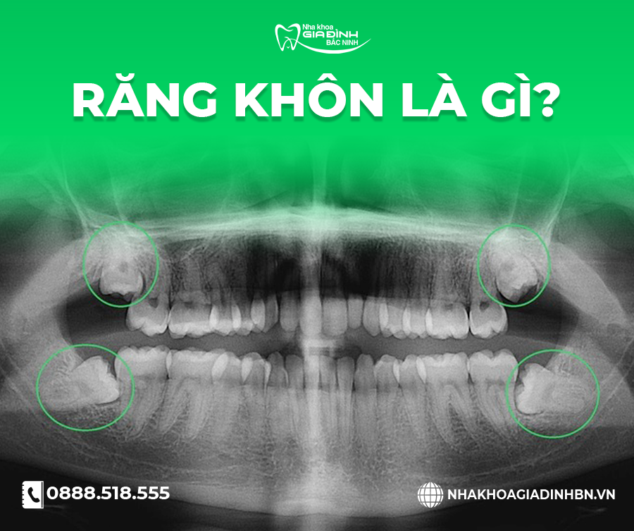 Răng khôn bị sâu