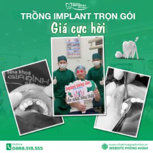 Địa Chỉ Trồng Răng Implant Uy Tín Bắc Ninh #1– Nha Khoa Gia Đình