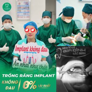 Địa Chỉ Trồng Răng Implant Uy Tín Bắc Ninh #1– Nha Khoa Gia Đình