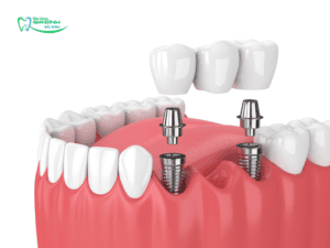So sánh trồng răng Implant và cầu răng sứ – Giải pháp nào tốt hơn?