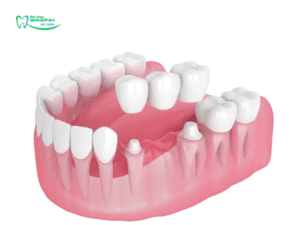So sánh trồng răng Implant và cầu răng sứ – Giải pháp nào tốt hơn?
