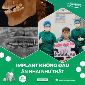 Review 10 kinh nghiệm trồng răng Implant thực tế – giúp bạn tránh rủi ro