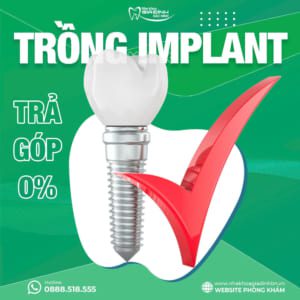 Review 10 kinh nghiệm trồng răng Implant thực tế – giúp bạn tránh rủi ro