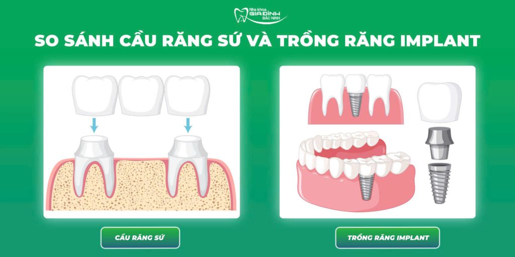 So sánh trồng răng Implant và cầu răng sứ – Giải pháp nào tốt hơn? 5 z7130006237686 feeef53c0031ec915c68a449cf7b7482