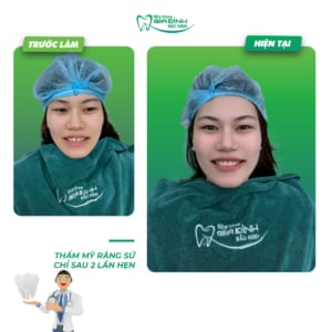 Gãy răng cửa có mọc lại không? Gãy răng cửa phải làm sao để khắc phục nhanh nhất?