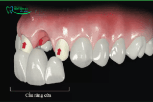Gãy răng cửa có mọc lại không? Gãy răng cửa phải làm sao để khắc phục nhanh nhất?