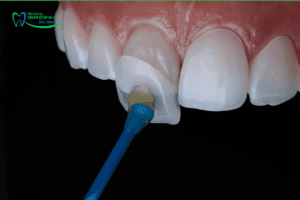 Gãy răng cửa có mọc lại không? Gãy răng cửa phải làm sao để khắc phục nhanh nhất?