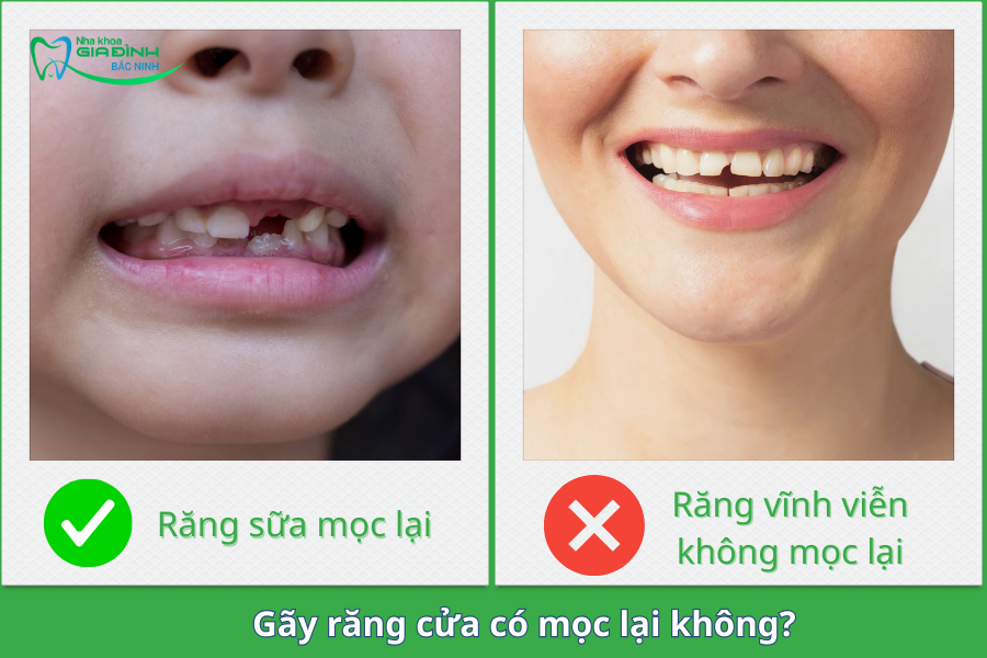 Gãy răng cửa có mọc lại không? Gãy răng cửa phải làm sao để khắc phục nhanh nhất? 7 gay rang cua co moc lai khong
