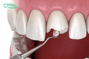 Gãy răng cửa có mọc lại không? Gãy răng cửa phải làm sao để khắc phục nhanh nhất?