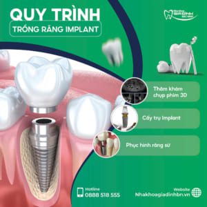 quy trinh trong rang implant