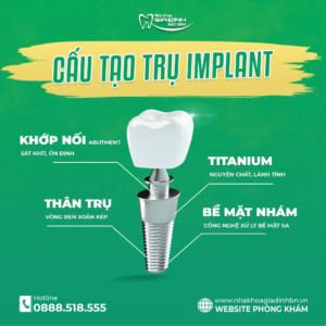 Trồng Răng Implant Mất Bao Lâu - Nha Khoa Gia Đình Bắc Ninh