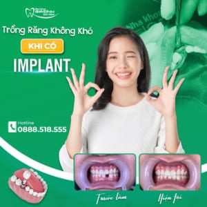 Gãy răng cửa có mọc lại không? Gãy răng cửa phải làm sao để khắc phục nhanh nhất?