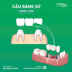 Mất 1 răng cửa nên trồng Implant hay làm cầu răng sứ? Giải pháp nào tốt nhất?