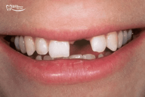 Mất 1 răng cửa nên trồng Implant hay làm cầu răng sứ? Giải pháp nào tốt nhất?