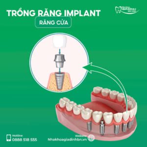 Mất 1 răng cửa nên trồng Implant hay làm cầu răng sứ? Giải pháp nào tốt nhất?