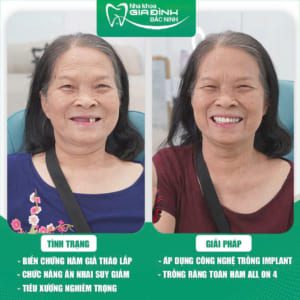 Người lớn tuổi có trồng Implant được không?