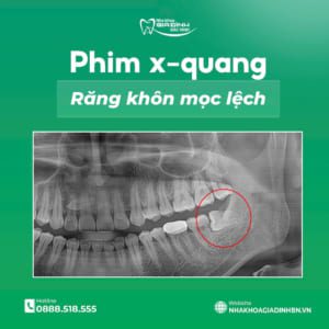 Quy trình nhổ răng khôn an toàn