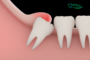 Dấu hiệu mọc răng khôn và trường hợp cần phải nhổ 3 Dấu hiệu mọc răng khôn và trường hợp cần phải nhổ