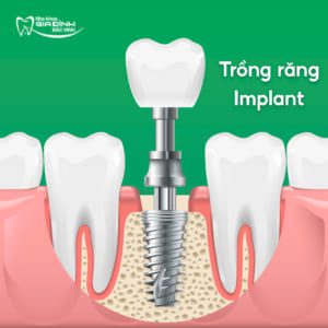 Trồng răng implant có bị hôi miệng không?