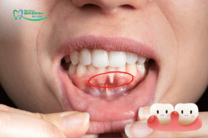 Trồng răng implant có bị hôi miệng không?