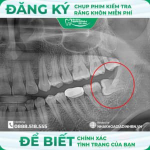 Có nên nhổ răng khôn? Khi nào cần nhổ và trường hợp không nên nhổ