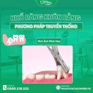 [Giải đáp] Có nên nhổ 4 răng khôn cùng lúc không? Bác sĩ tư vấn chi tiết