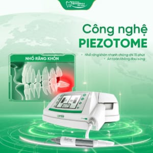 Răng khôn bị sâu có trám được không hay nên nhổ bỏ?