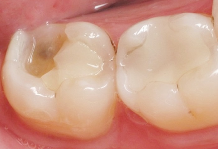Hàn Răng Sâu Giữ Được Bao Lâu? Bí Quyết Giúp Miếng Trám Bền Đẹp Nhiều Năm