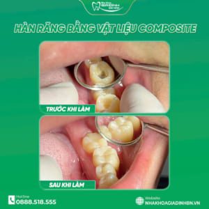 Hàn Răng Sâu Bao Nhiêu Tiền? Bảng Giá Hàn Răng Mới Nhất Tại Bắc Ninh