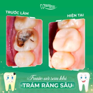 Hàn Răng Sâu Bao Nhiêu Tiền? Bảng Giá Hàn Răng Mới Nhất Tại Bắc Ninh
