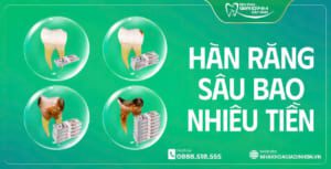 Hàn Răng Sâu Bao Nhiêu Tiền? Bảng Giá Hàn Răng Mới Nhất Tại Bắc Ninh