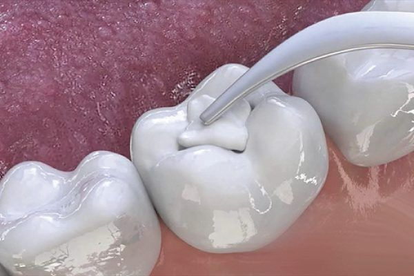 Hàn Răng Sâu Có Đau Không? Bác Sĩ Giải Đáp Chi Tiết