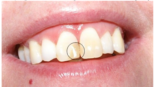 Hàn Răng Sâu Giữ Được Bao Lâu? Bí Quyết Giúp Miếng Trám Bền Đẹp Nhiều Năm