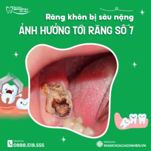 Răng khôn bị sâu có trám được không hay nên nhổ bỏ?