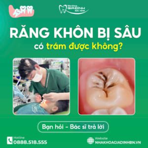 Răng khôn bị sâu có trám được không hay nên nhổ bỏ?