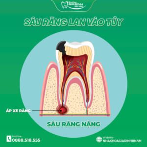 Hàn Răng Sâu Bao Nhiêu Tiền? Bảng Giá Hàn Răng Mới Nhất Tại Bắc Ninh