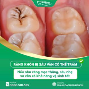 Răng khôn bị sâu có trám được không hay nên nhổ bỏ?