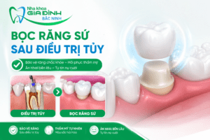 Chữa Tủy Răng Mất Bao Lâu? Mất Mấy Buổi Điều Trị?