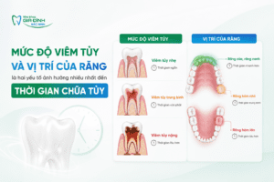 dieu tri tuy rang mat bao lau