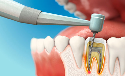 Chữa Tủy Răng Có Đau Không?