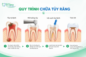 Chữa Tủy Răng Mất Bao Lâu? Mất Mấy Buổi Điều Trị?