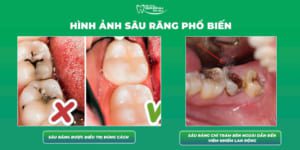 Trám Răng Sâu Có Lấy Tủy Không?