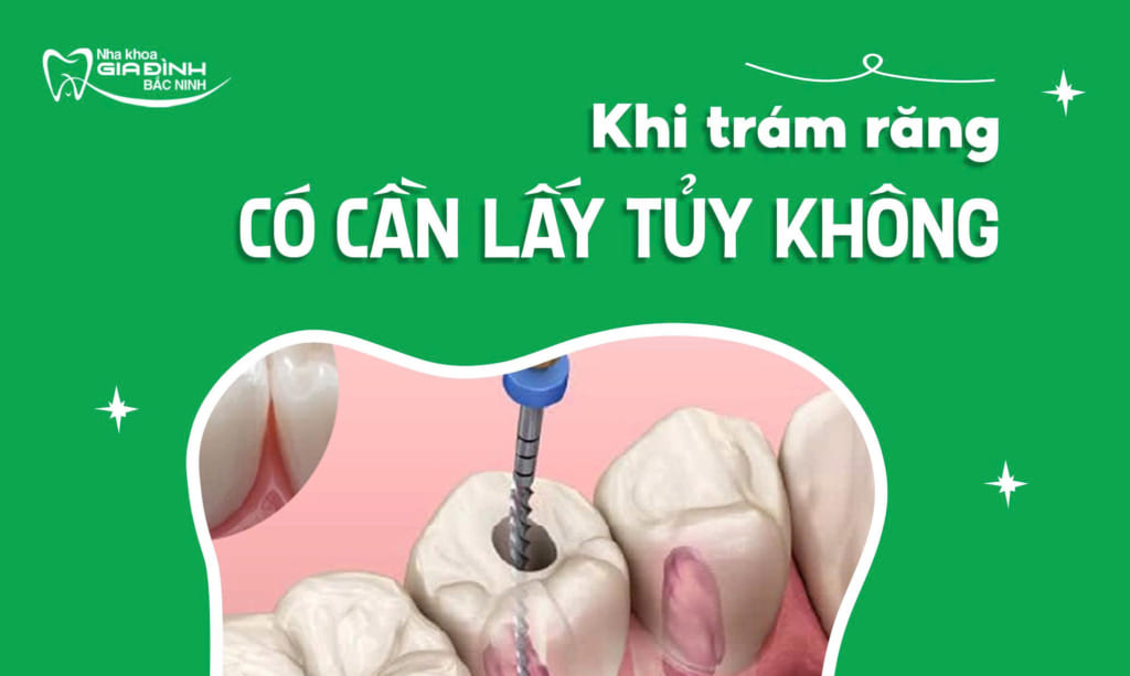 tram rang sau co lay tuy khong e1782546594590
