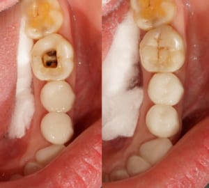 Trám Răng Sâu Có Lấy Tủy Không?