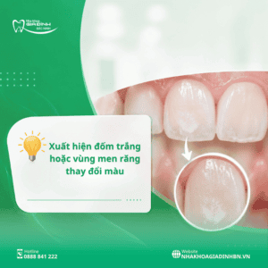 Dấu Hiệu Sâu Răng: 8 Triệu Chứng Dễ Nhận Biết 3 Dấu hiệu sâu răng giai đoạn sớm trên bề mặt răng