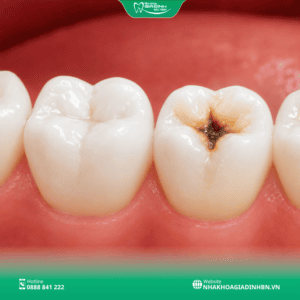 Dấu Hiệu Sâu Răng: 8 Triệu Chứng Dễ Nhận Biết 2 Dấu hiệu sâu răng thường gặp