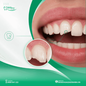 Dấu Hiệu Sâu Răng: 8 Triệu Chứng Dễ Nhận Biết 5 Dấu Hiệu Sâu Răng: 8 Triệu Chứng Dễ Nhận Biết