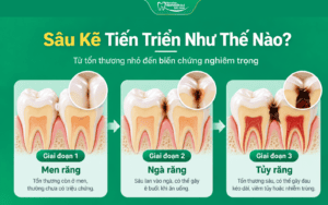 Sâu Kẽ Răng: Dấu Hiệu Khó Nhận Biết Và Cách Điều Trị 3 các giai đoạn sâu kẽ răng